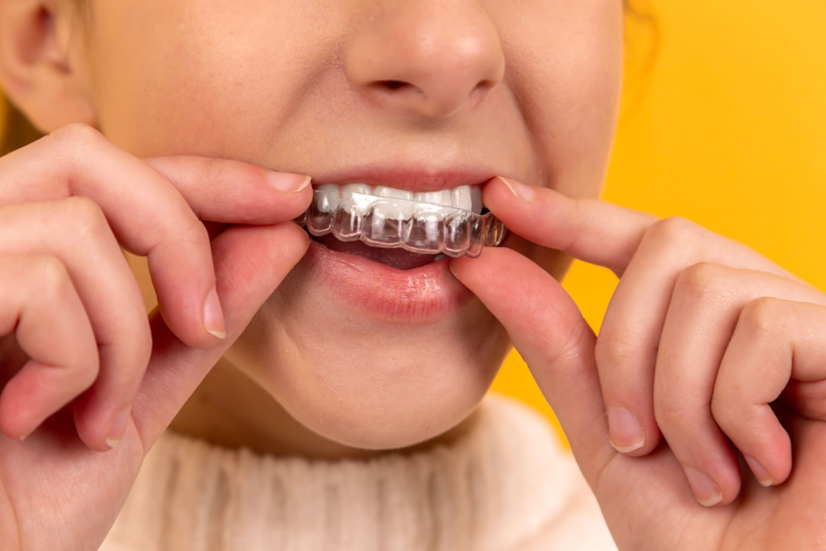 Person fitting a clear dental appliance similar to a custom mouthguard